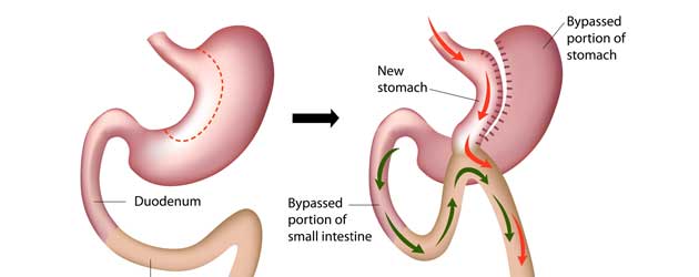 gastric-bypass-surgery-plastic-surgery-hub